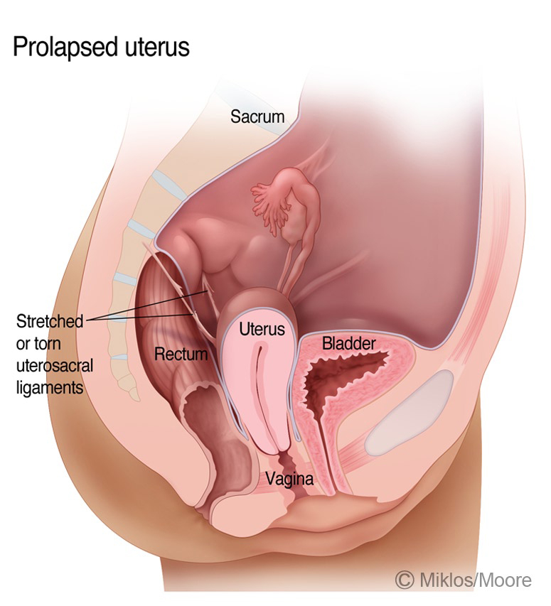 Pelvic Organ Prolapse Beverly Hills Vaginal Prolapse Los